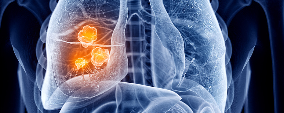 新的影像学技术可早期诊断肺癌
