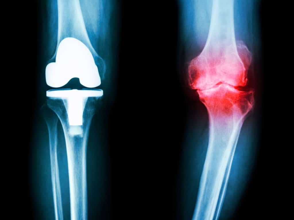 霍尔博士研究了骨关节炎（OA）结果。她工作的主要主题是适当使用OA的髋关节和膝关节置换手术。