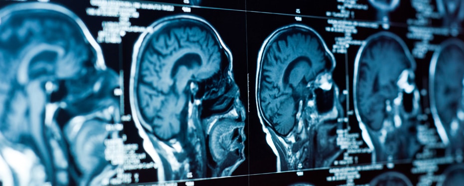 光疗法改善创伤性脑损伤后的认知功能