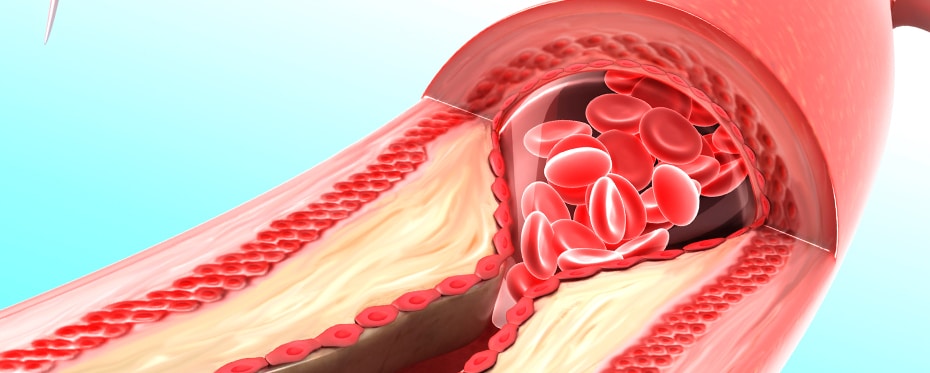 一种潜在的心血管疾病预防工具