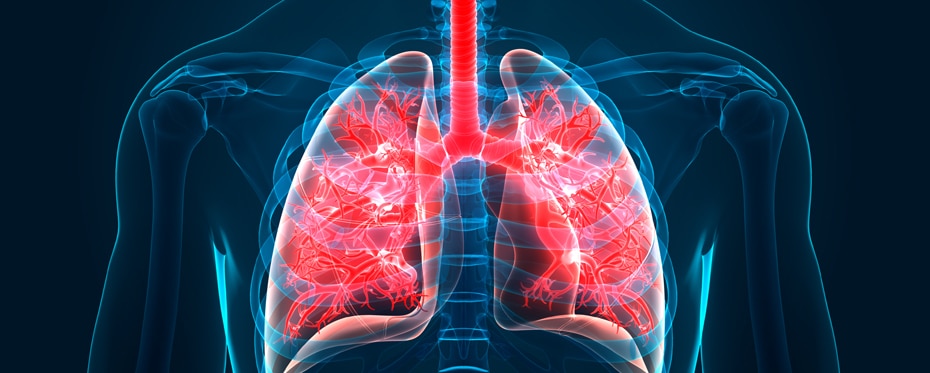 开发一种新型吸入治疗用于治疗支气管炎梗阻栓塞综合征