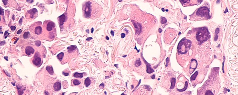 Yamaoka博士研究了肺癌患者耐药机制。