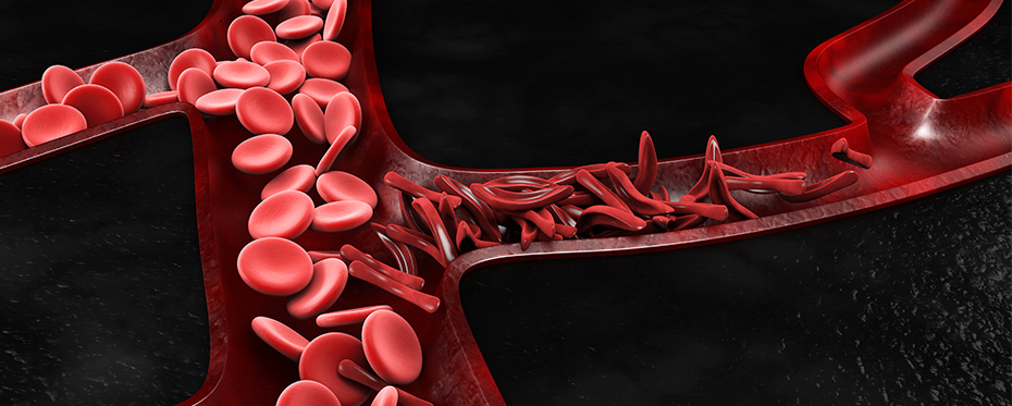镰刀形红细胞可导致血管阻塞。