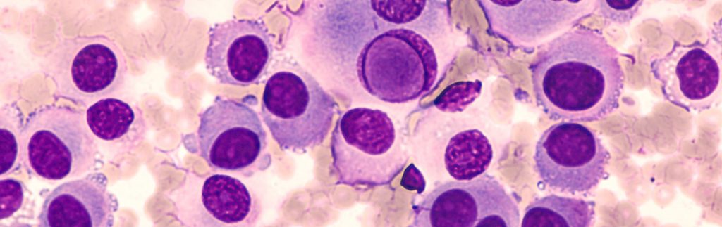 研究人员正在开发用于转移性黑素瘤患者的新型治疗药物组合的测试平台。