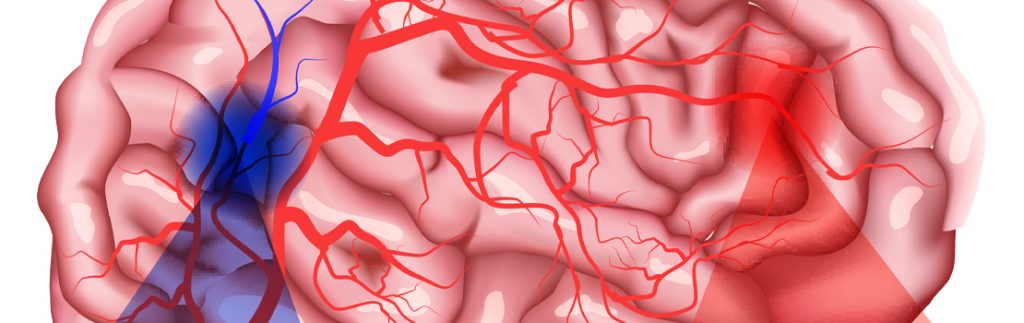 由于中风，脑组织不再接受氧气。