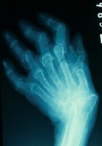 X光片病人与RA骨架反转