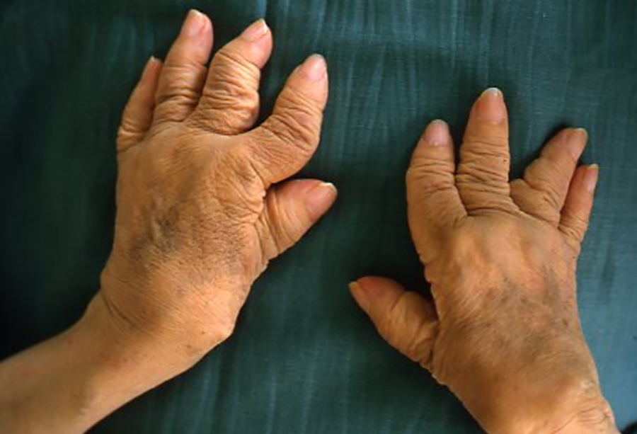 显示疾病效果的病人与RA